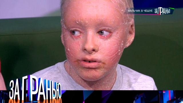 «Мальчик в чешуе»